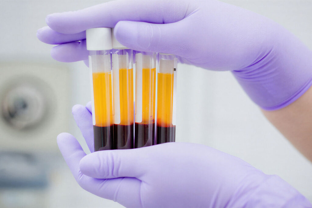 close up of PRF tubes being held in the dental labs