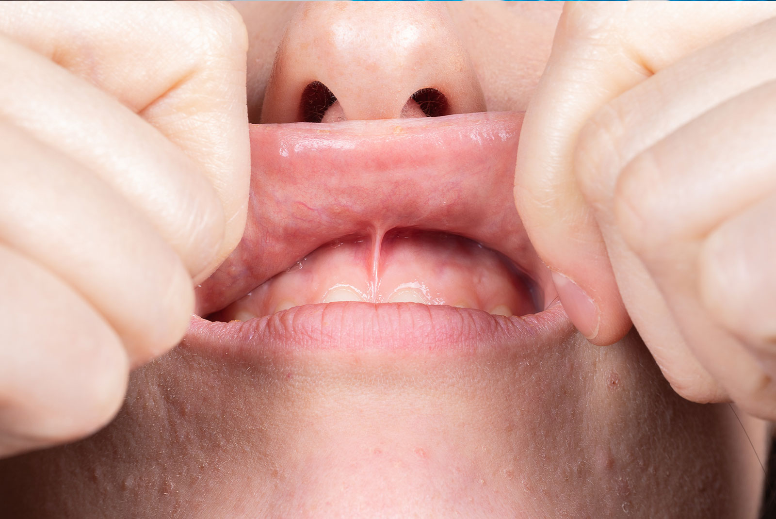 Medical inspection of the superior labial frenulum to evaluate the need for frenectomy oral surgery