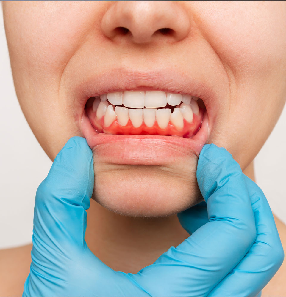 close up of dental patient with inflamed gums