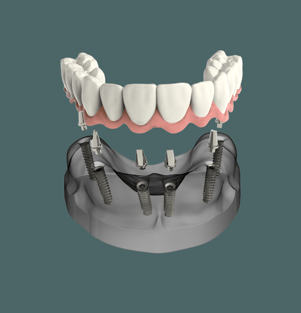 model full arch