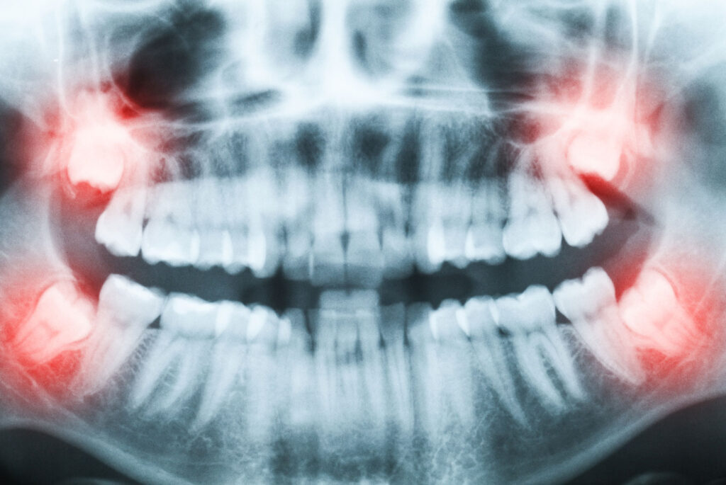 close up of x ray image of wisdom teeth